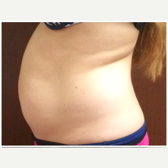 25-34 year old woman treated with SculpSure before 3265824