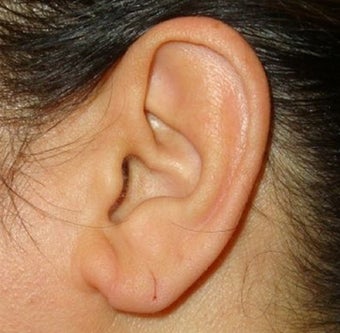 40 Year Old Female Treated for Ear Lobe Laxity 1367297