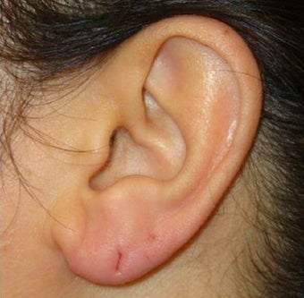 40 Year Old Female Treated for Ear Lobe Laxity 1367297