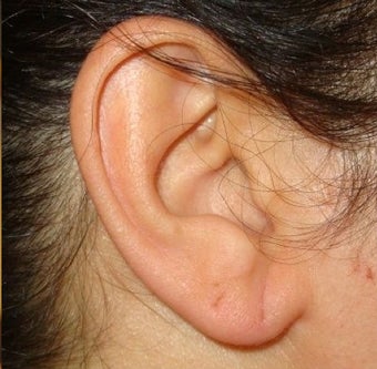 40 Year Old Female Treated for Ear Lobe Laxity before 1367297