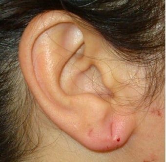 40 Year Old Female Treated for Ear Lobe Laxity after 1367297