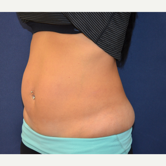 35-44 year old woman treated with CoolSculpting before 3487152