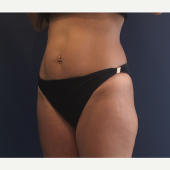 35-44 year old woman treated with CoolSculpting after 3487152