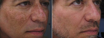 IPL Treatment before 1340177