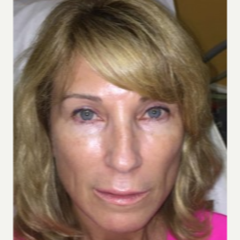 45-54 year old woman treated with Juvederm after 3658496