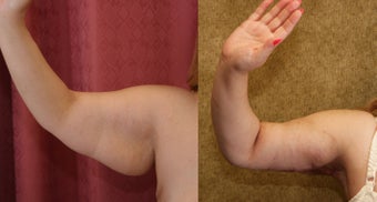 brachioplasty for hispanic woman before 993801