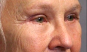 55-64 year old woman treated with Eyelid Surgery after 3046867