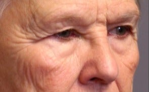 55-64 year old woman treated with Eyelid Surgery before 3046867
