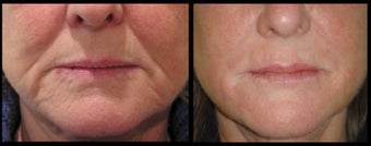 56 year old lady for lower third facial volume loss treated with 3ml Restylane dermal filler before 966275