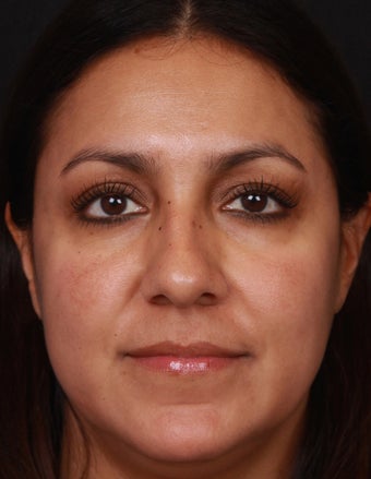Brightening Facials and Laser for Melasma after 1358757