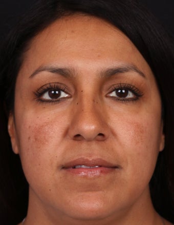 Brightening Facials and Laser for Melasma before 1358757