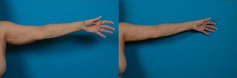 70-year-old woman treated with an Arm Lift. before 574593