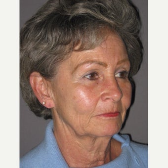 65-74 year old woman treated with Lifestyle Lift before 2242812
