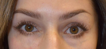 30 year old female, with under eye hollowness (tear trough deformity) underwent filler injection. after 3789515