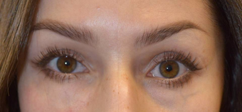 30 year old female, with under eye hollowness (tear trough deformity) underwent filler injection. before 3789515