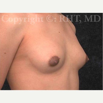 25 year old M-F transgender patient treated with 2-stage Breast Augmentation before 2246912