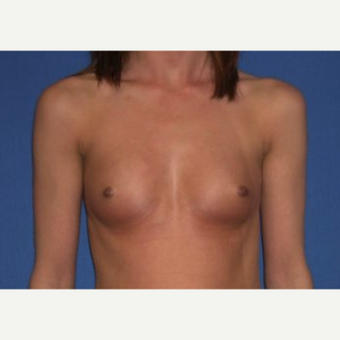 25-34 year old woman treated with Breast Augmentation before 3220066
