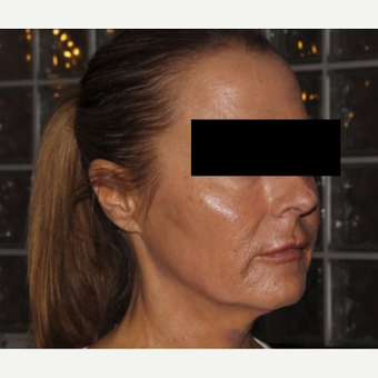 45-54 year old woman treated with Infini RF after 3816759