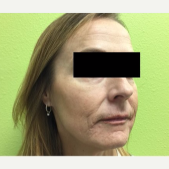 45-54 year old woman treated with Infini RF before 3816759