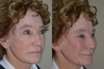 71 year old non-surgical treatment for facial volume deflation. before 1270751