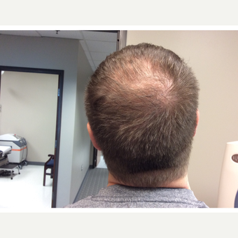 35-44 year old man treated with PRP for Hair Loss before 3059165