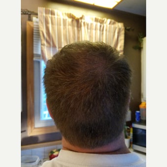 35-44 year old man treated with PRP for Hair Loss after 3059165