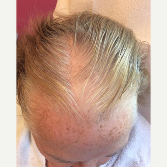 65-74 year old woman treated with PRP for Hair Loss before 3452205