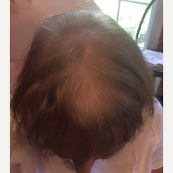 65-74 year old woman treated with PRP for Hair Loss after 3452205