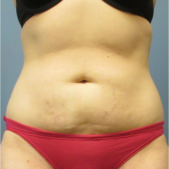 35-44 year old woman treated with CoolSculpting before 3764012
