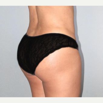 35-44 year old woman treated with Brazilian Butt Lift after 3207378