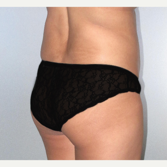 35-44 year old woman treated with Brazilian Butt Lift before 3207378