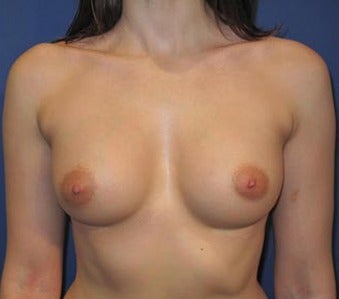 Bilateral Breast Augmentation-Patient has type I Tuberous Breast Deformity - Pre- & 9 Months Post-op after 3473937