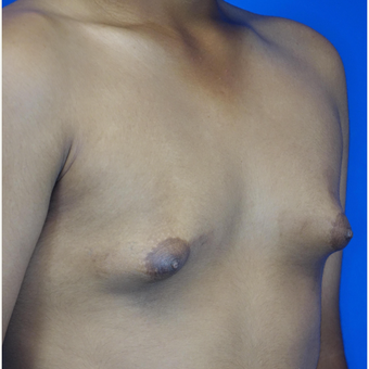 18-24 year old man treated with Male Breast Reduction before 3542901