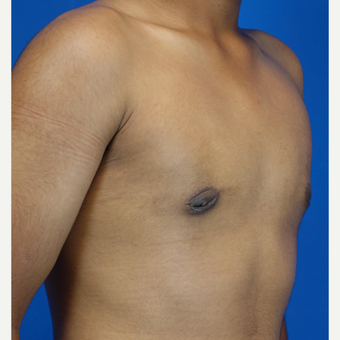 18-24 year old man treated with Male Breast Reduction after 3542901