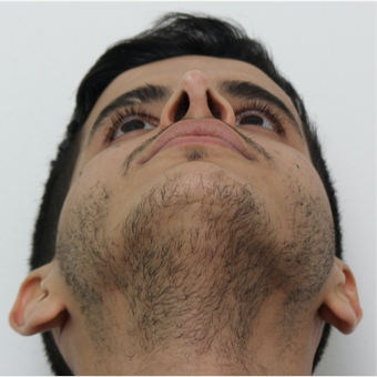 25-34 year old man treated with Revision Rhinoplasty after 3583845