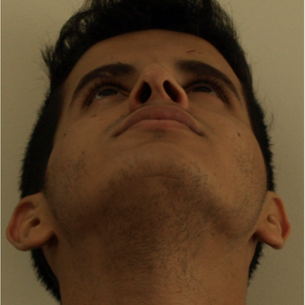 25-34 year old man treated with Revision Rhinoplasty before 3583845
