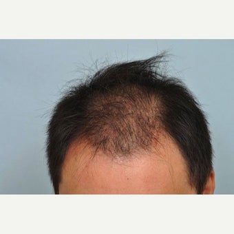 FUE Hair Transplant - 2,500 grafts and PRP 1649915
