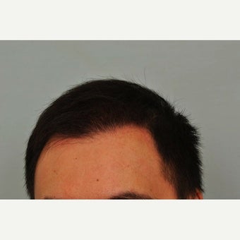 FUE Hair Transplant - 2,500 grafts and PRP 1649915