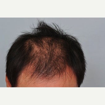 FUE Hair Transplant - 2,500 grafts and PRP before 1649915