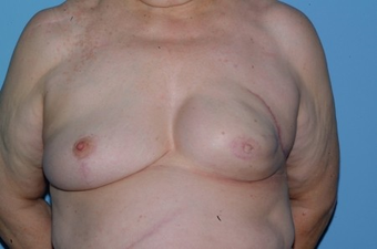 70-year-old Breast Reconstruction patient had bilateral reconstruction after 963246