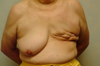 70-year-old Breast Reconstruction patient had bilateral reconstruction before 963246