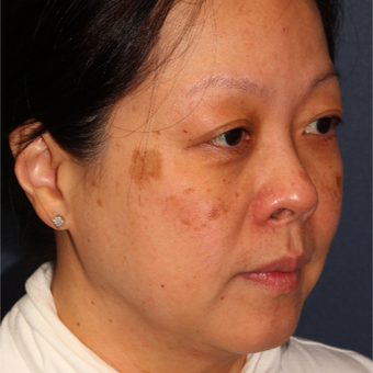 53 year old woman treated with Fraxel Dual and q-switched alex laser for age and brown spots before 3616912