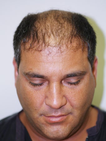 Hair Transplant- 2800 grafts before 173707