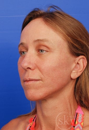 Facelift, Fat Transfer, Browlift, Fractionated Laser after 3114533