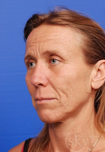Facelift, Fat Transfer, Browlift, Fractionated Laser before 3114533