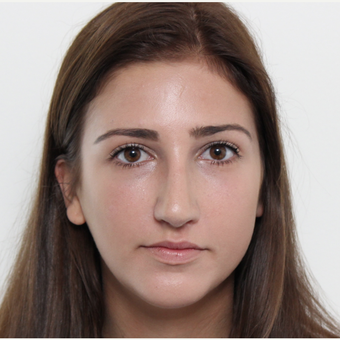 18-24 year old woman treated with Rhinoplasty after 3366748