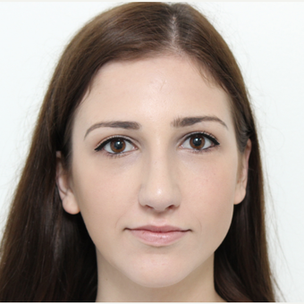 18-24 year old woman treated with Rhinoplasty before 3366748