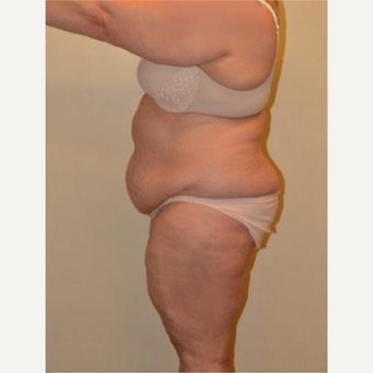 45-54 year old woman treated with Tummy Tuck before 3658168