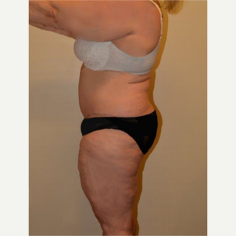 45-54 year old woman treated with Tummy Tuck after 3658168