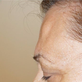 56 year old woman treated with Lipoma Removal from Forehead before 2065265